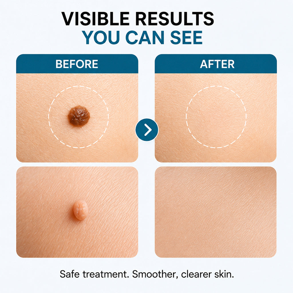 Xorita Laser Mole and Wart Removal Pen