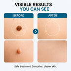 Xorita Laser Mole and Wart Removal Pen