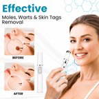 Xorita Laser Mole and Wart Removal Pen