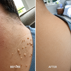 Xorita Laser Mole and Wart Removal Pen