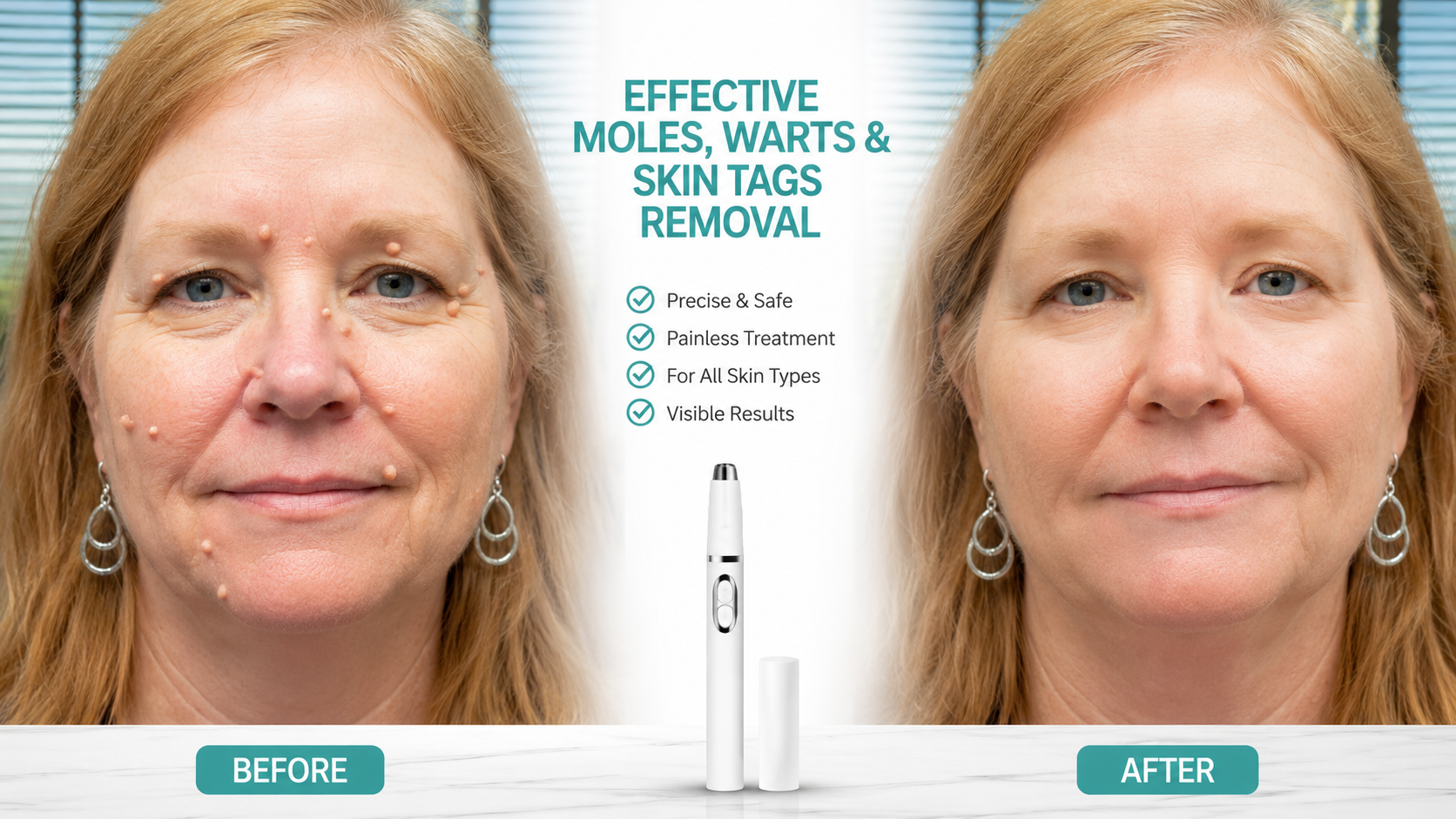 Xorita Laser Mole and Wart Removal Pen